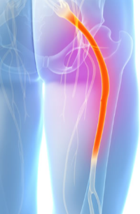 How a Dermatome Map Helps Identify Nerve-Related Pain